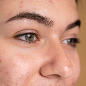 Blemishes / Blackheads