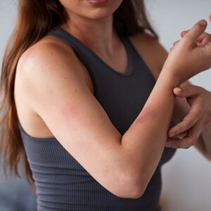 Eczema / Psoriasis / Dermatitis